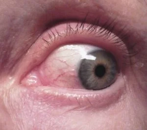 fluorometholone eye swelling